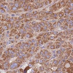 Immunohistochemistry-Paraffin: TID1 Antibody [NBP2-34066] - liver cancer