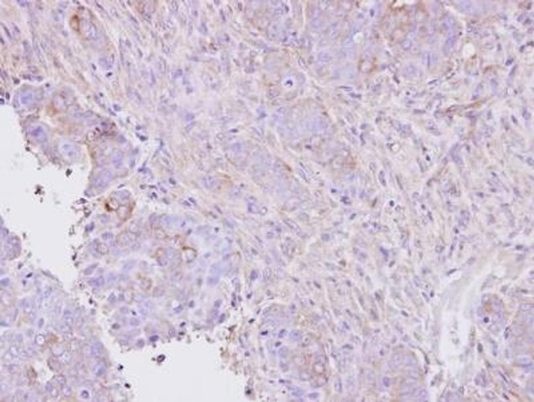 Immunohistochemistry: Activin RIA/ALK-2/Activin Receptor Type 1 Antibody [NBP1-33500] - NCIN87 xenograft