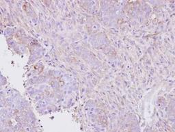 Immunohistochemistry: Activin RIA/ALK-2/Activin Receptor Type 1 Antibody [NBP1-33500] - NCIN87 xenograft