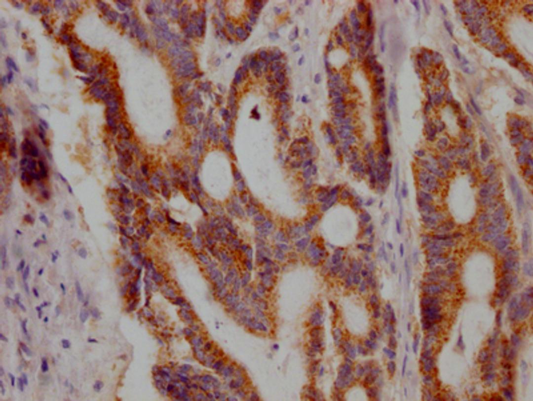 IHC image of CSB-RA227790A0HU diluted at 1:100 and staining in paraffin-embedded human colon cancer performed on a Leica BondTM system. After dewaxing and hydration, antigen retrieval was mediated by high pressure in a citrate buffer (pH 6.0). Section was blocked with 10% normal goat serum 30min at RT. Then primary antibody (1% BSA) was incubated at 4℃ overnight. The primary is detected by a Goat anti-rabbit IgG polymer labeled by HRP and visualized using 0.05% DAB.