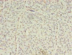 Immunohistochemistry of paraffin-embedded human breast cancer using CSB-PA618004LA01HU at dilution of 1:100