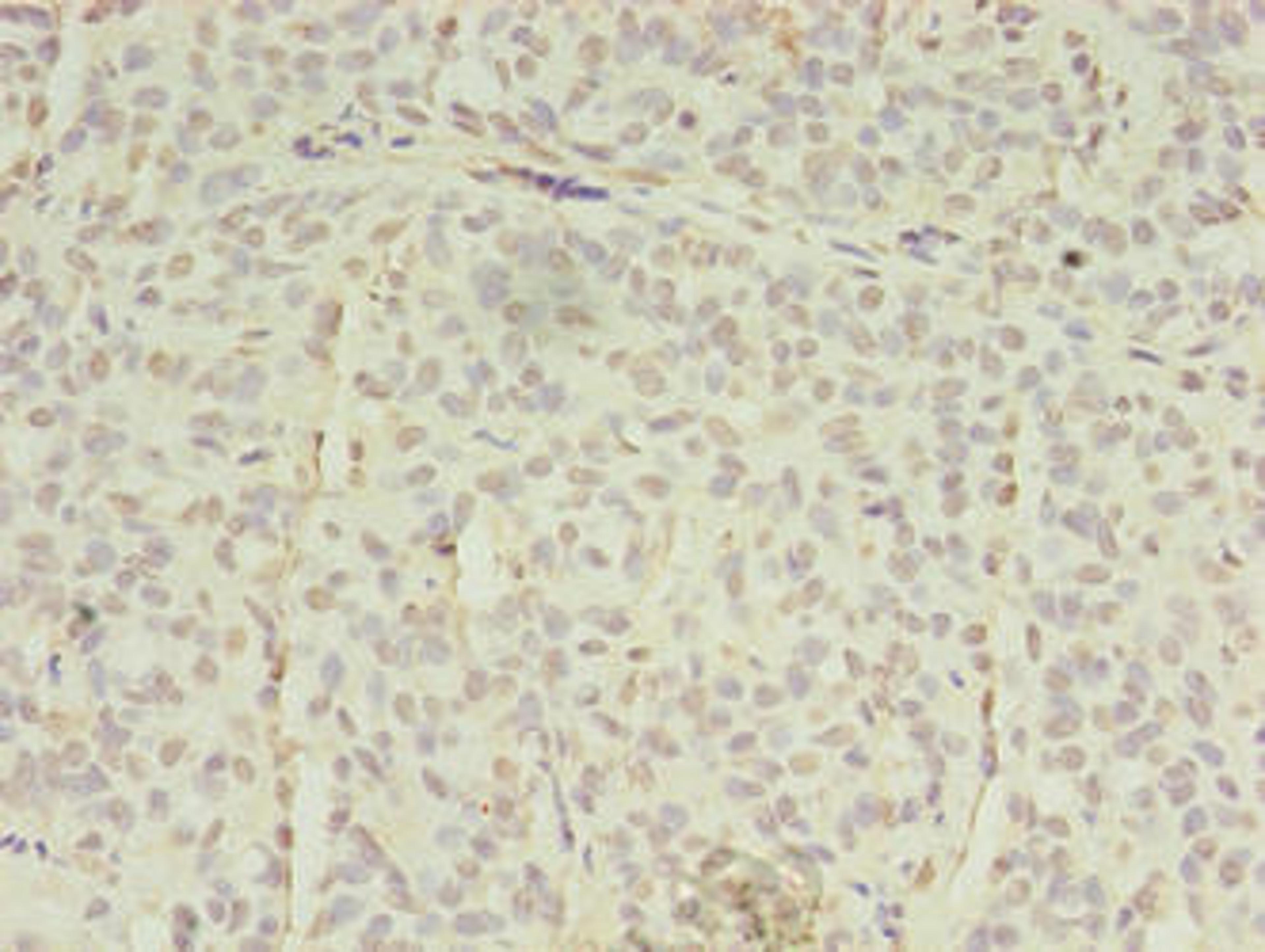 Immunohistochemistry of paraffin-embedded human breast cancer using CSB-PA618004LA01HU at dilution of 1:100