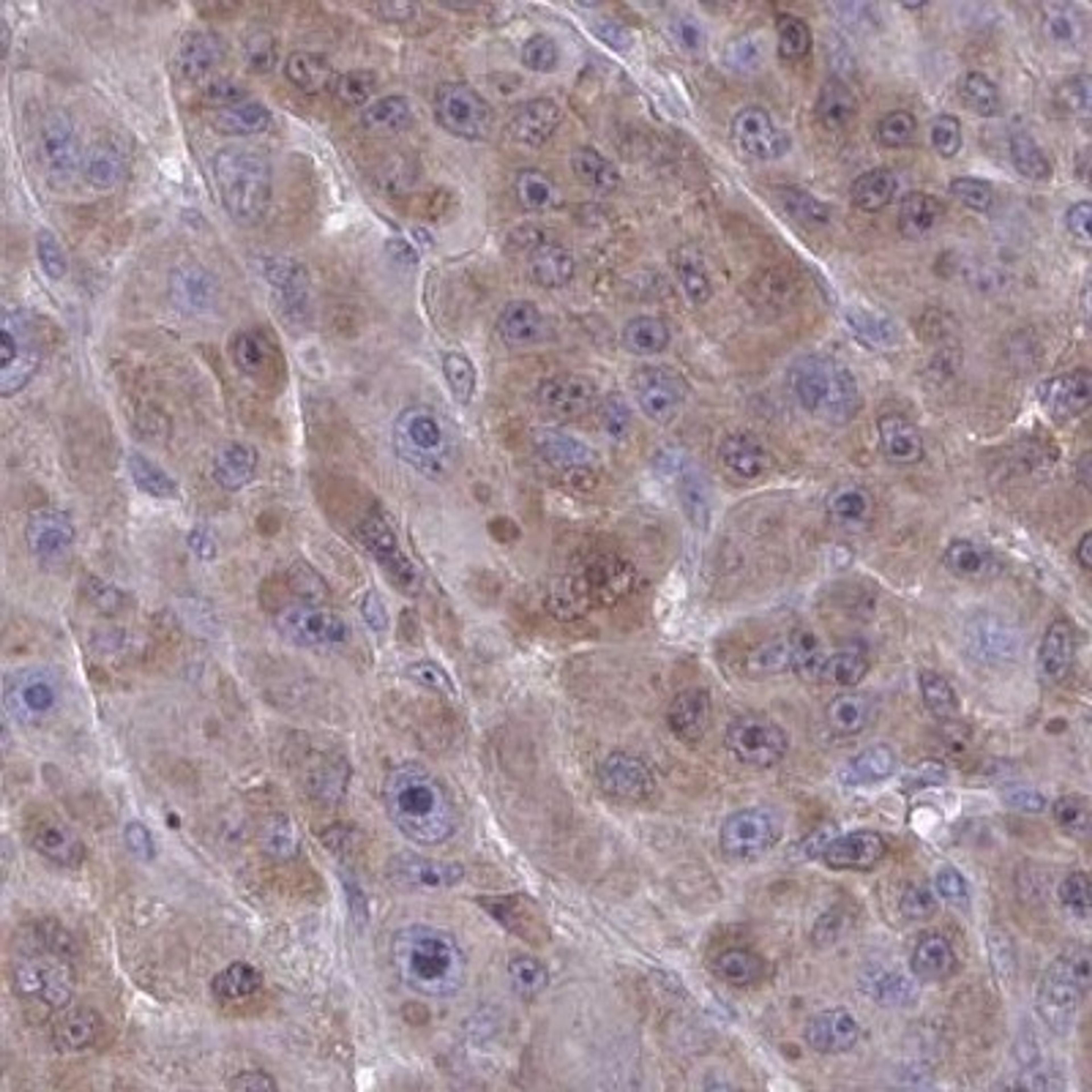 Immunohistochemistry: L3HYPDH Antibody [NBP2-31648] - liver cancer