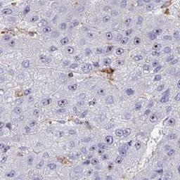 Immunohistochemistry: Vitrin Antibody [NBP2-31722] - liver cancer