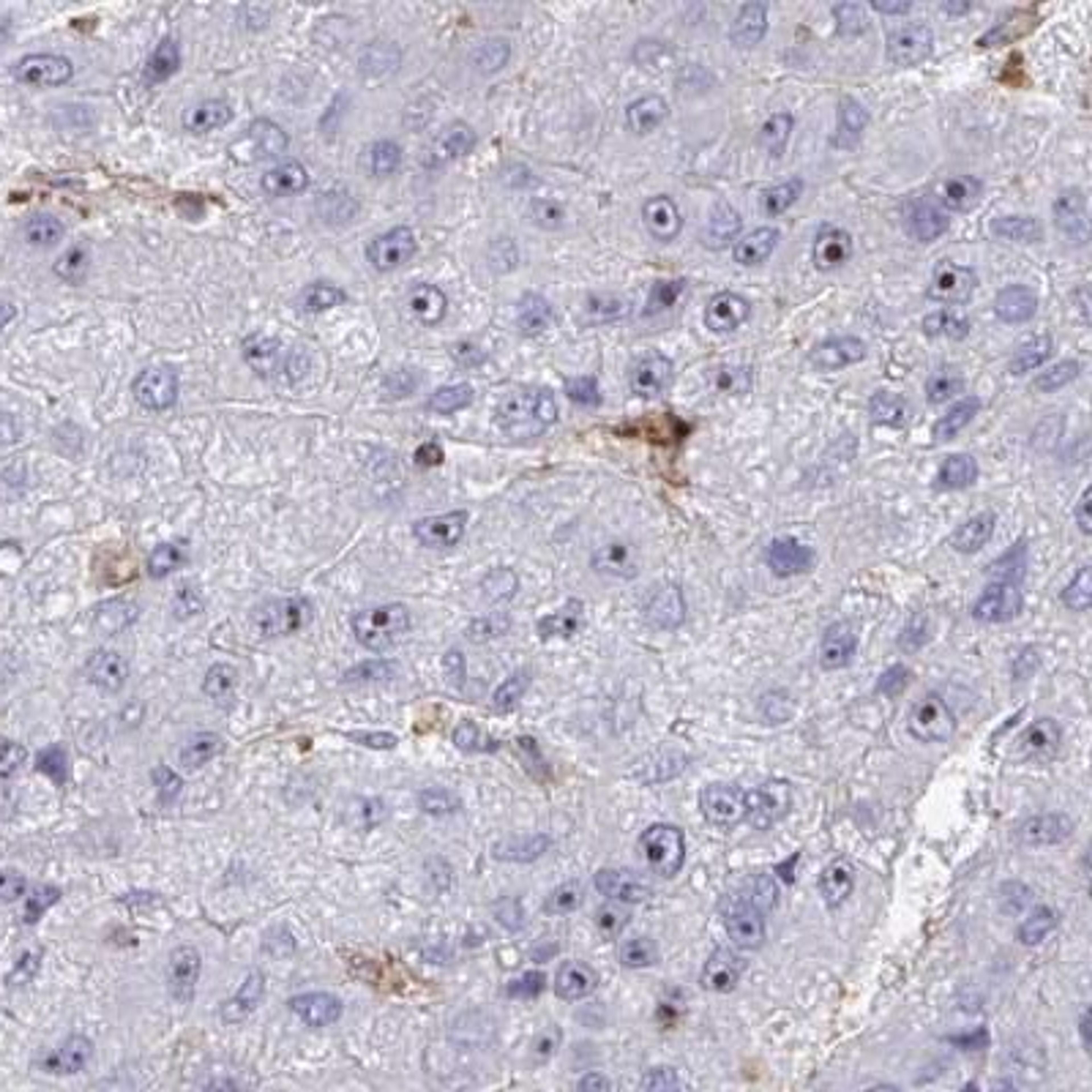 Immunohistochemistry: Vitrin Antibody [NBP2-31722] - liver cancer