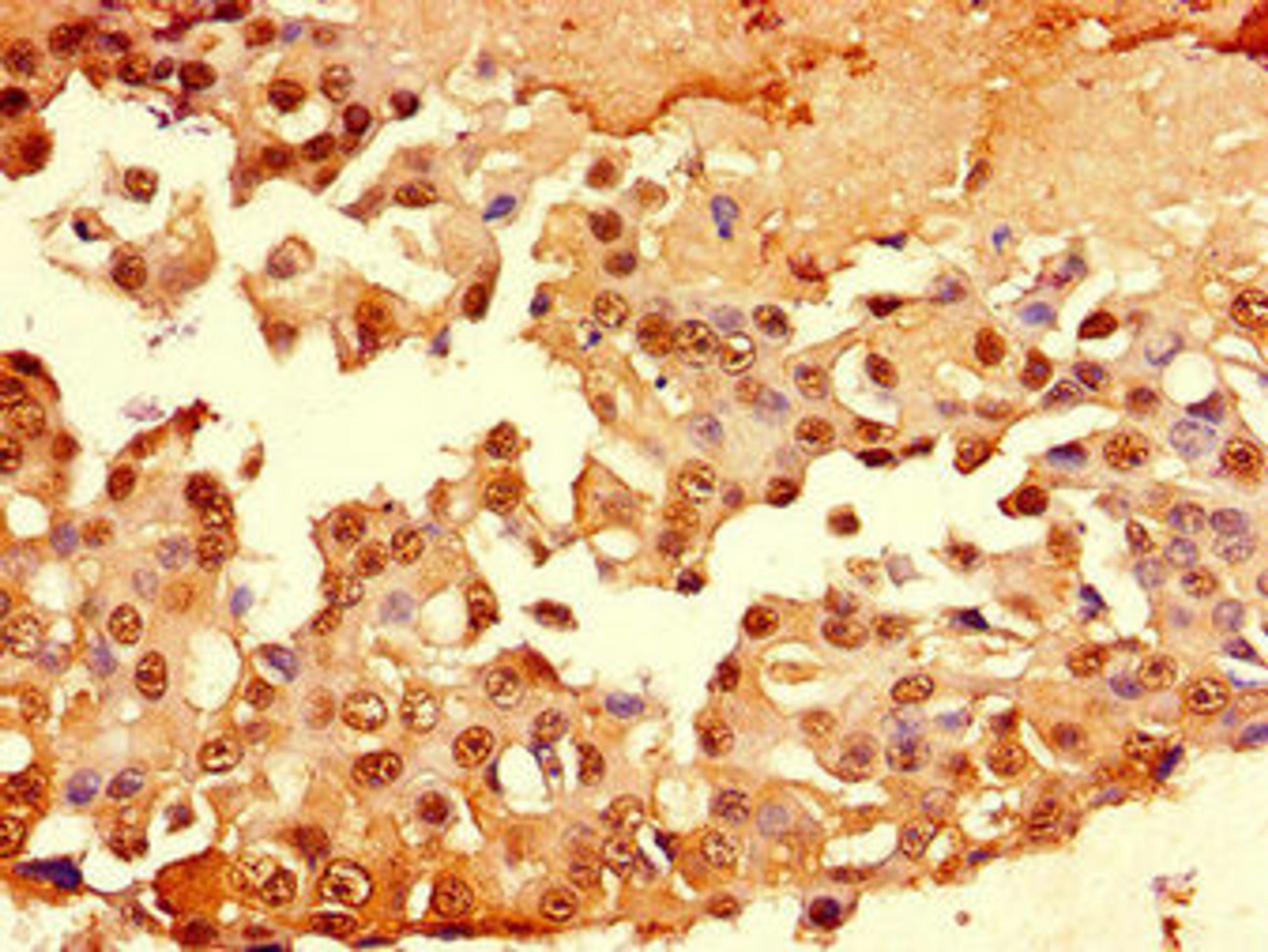 Immunohistochemistry of paraffin-embedded human breast cancer using CSB-PA11319A0Rb at dilution of 1:100