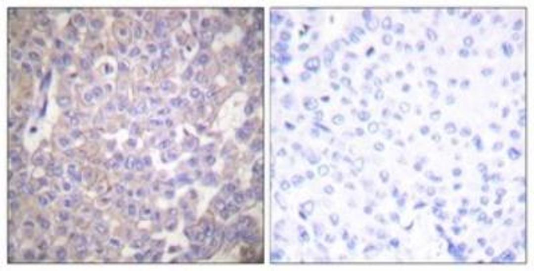 Immunohistochemistry-Paraffin: Claudin-2 Antibody [NBP1-67516] - Analysis of paraffin-embedded human breast carcinoma tissue, using Claudin 2 Antibody. The picture on the right is treated with the synthesized peptide.