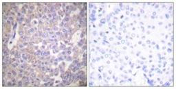 Immunohistochemistry-Paraffin: Claudin-2 Antibody [NBP1-67516] - Analysis of paraffin-embedded human breast carcinoma tissue, using Claudin 2 Antibody. The picture on the right is treated with the synthesized peptide.