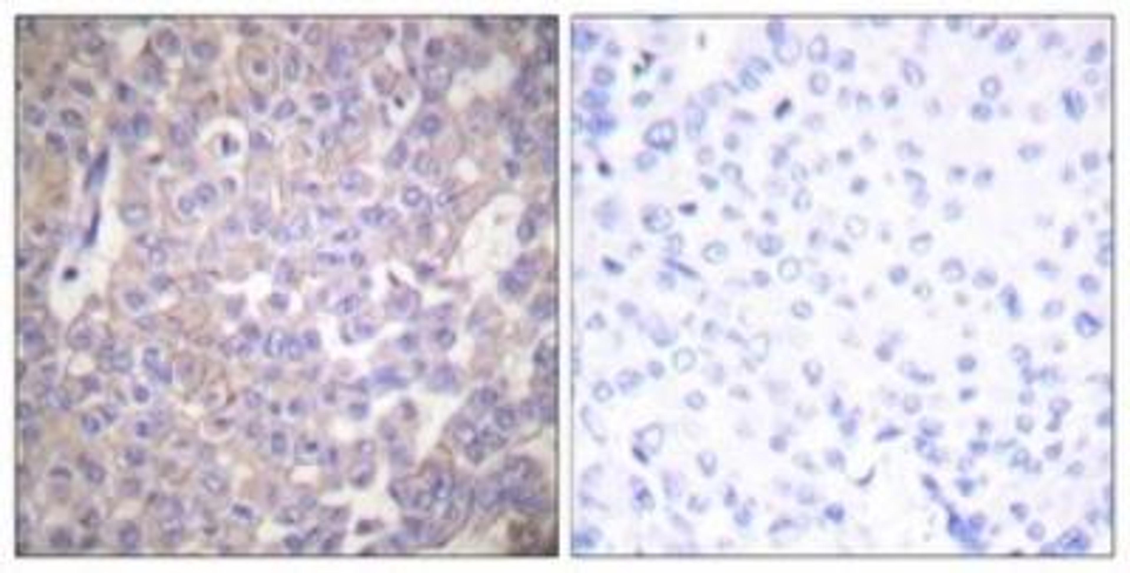 Immunohistochemistry-Paraffin: Claudin-2 Antibody [NBP1-67516] - Analysis of paraffin-embedded human breast carcinoma tissue, using Claudin 2 Antibody. The picture on the right is treated with the synthesized peptide.