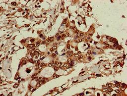 Immunohistochemistry of paraffin-embedded human pancreatic cancer using CSB-PA608122LA01HU at dilution of 1:100