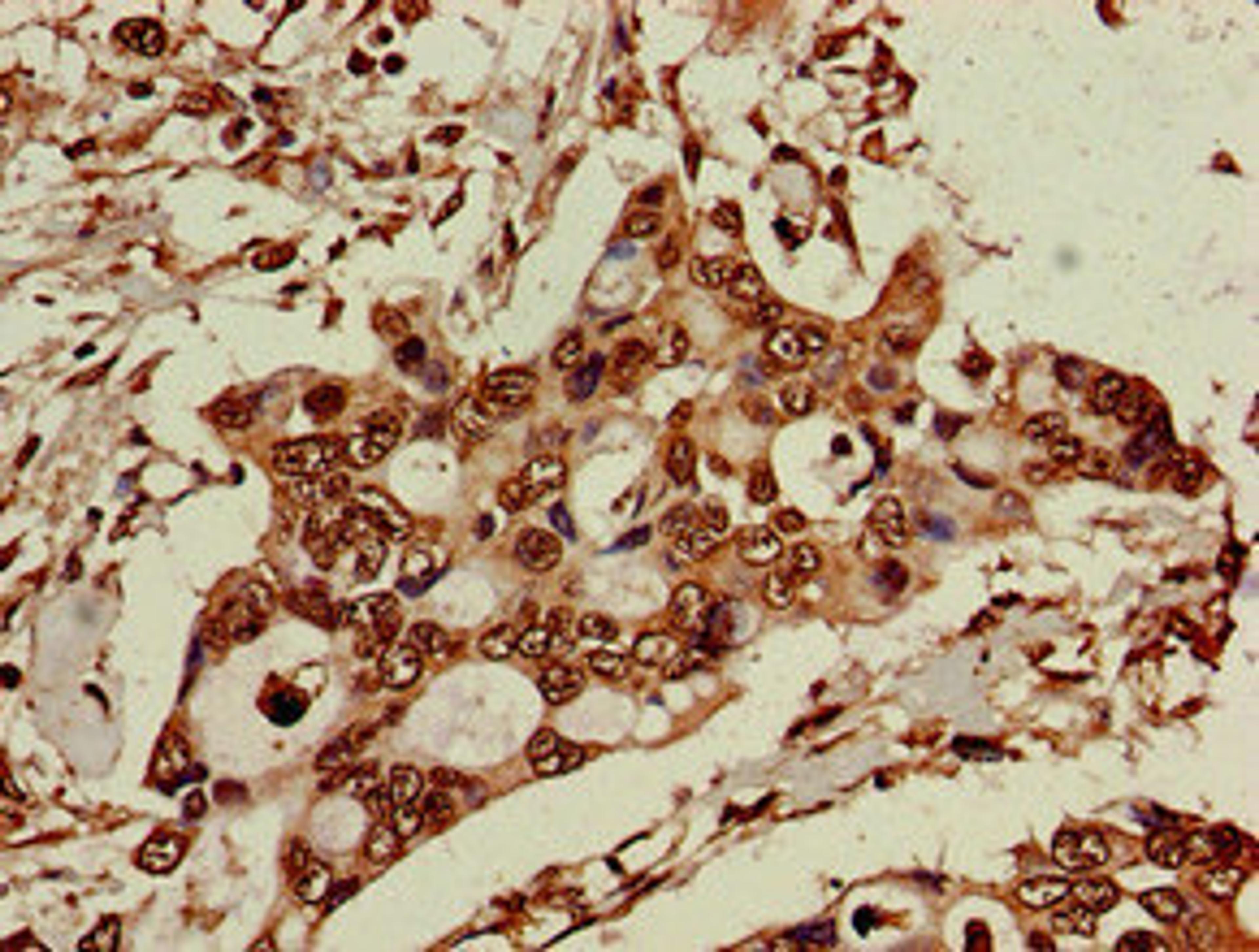 Immunohistochemistry of paraffin-embedded human pancreatic cancer using CSB-PA608122LA01HU at dilution of 1:100