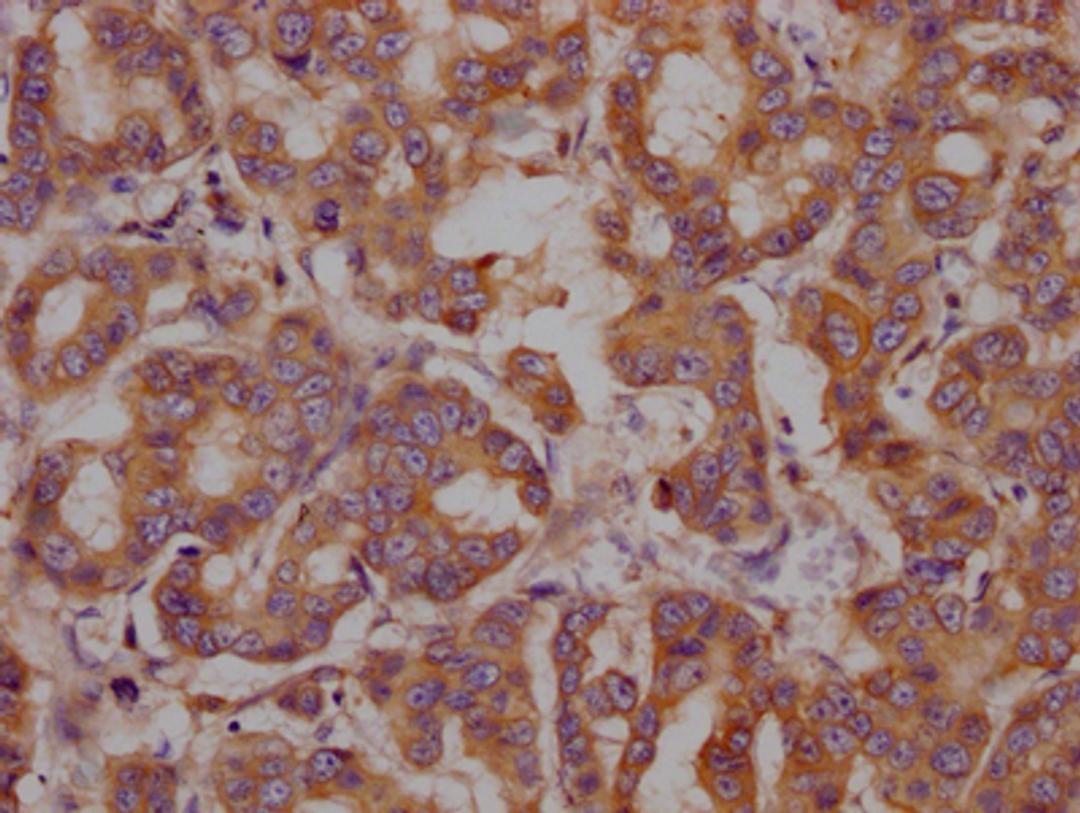 IHC image of CSB-RA847116A0HU diluted at 1:100 and staining in paraffin-embedded human breast cancer performed on a Leica BondTM system. After dewaxing and hydration, antigen retrieval was mediated by high pressure in a citrate buffer (pH 6.0). Section was blocked with 10% normal goat serum 30min at RT. Then primary antibody (1% BSA) was incubated at 4℃ overnight. The primary is detected by a Goat anti-rabbit IgG polymer labeled by HRP and visualized using 0.05% DAB.