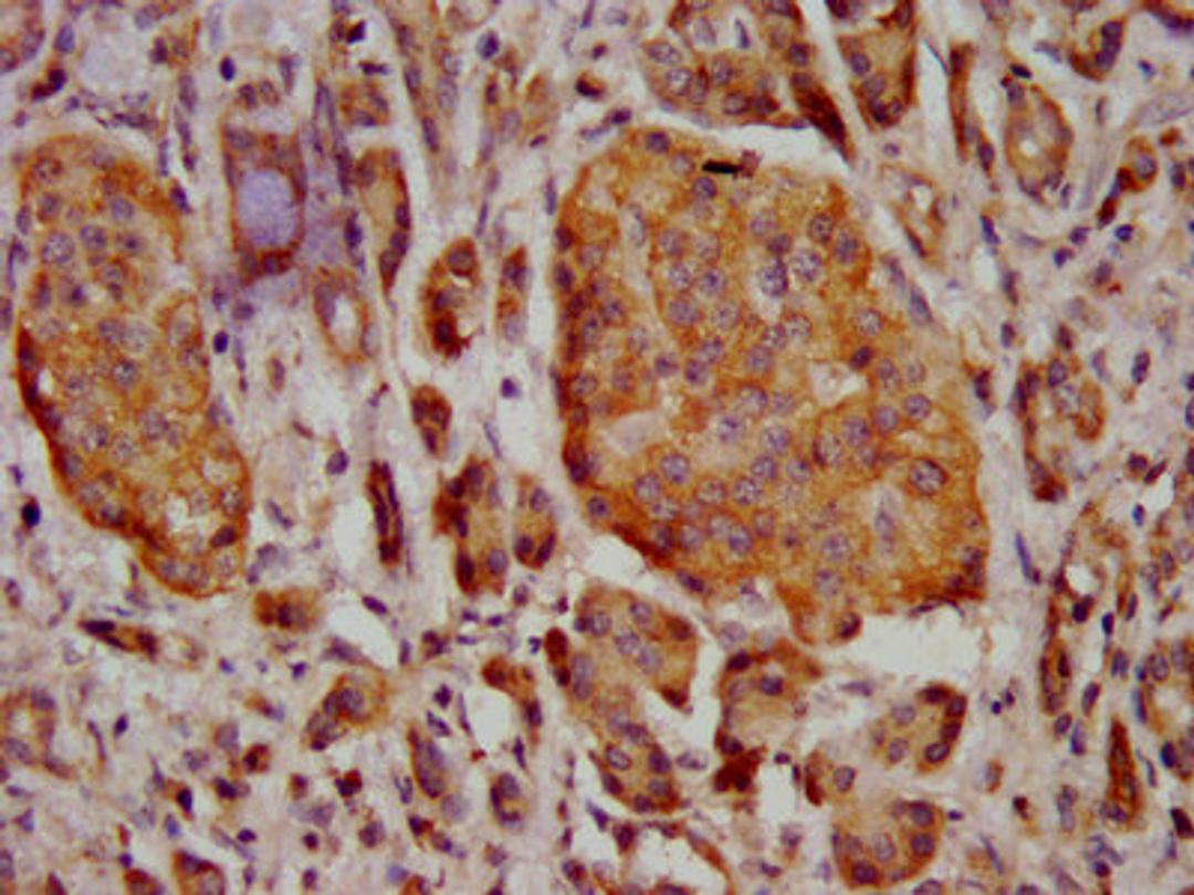 IHC image of CSB-PA04639A0Rb diluted at 1:400 and staining in paraffin-embedded human pancreatic cancer performed on a Leica BondTM system. After dewaxing and hydration, antigen retrieval was mediated by high pressure in a citrate buffer (pH 6.0). Section was blocked with 10% normal goat serum 30min at RT. Then primary antibody (1% BSA) was incubated at 4°C overnight. The primary is detected by a biotinylated secondary antibody and visualized using an HRP conjugated SP system.