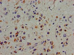 Immunohistochemistry of paraffin-embedded human glioma using CSB-PA613494LA01HU at dilution of 1:100