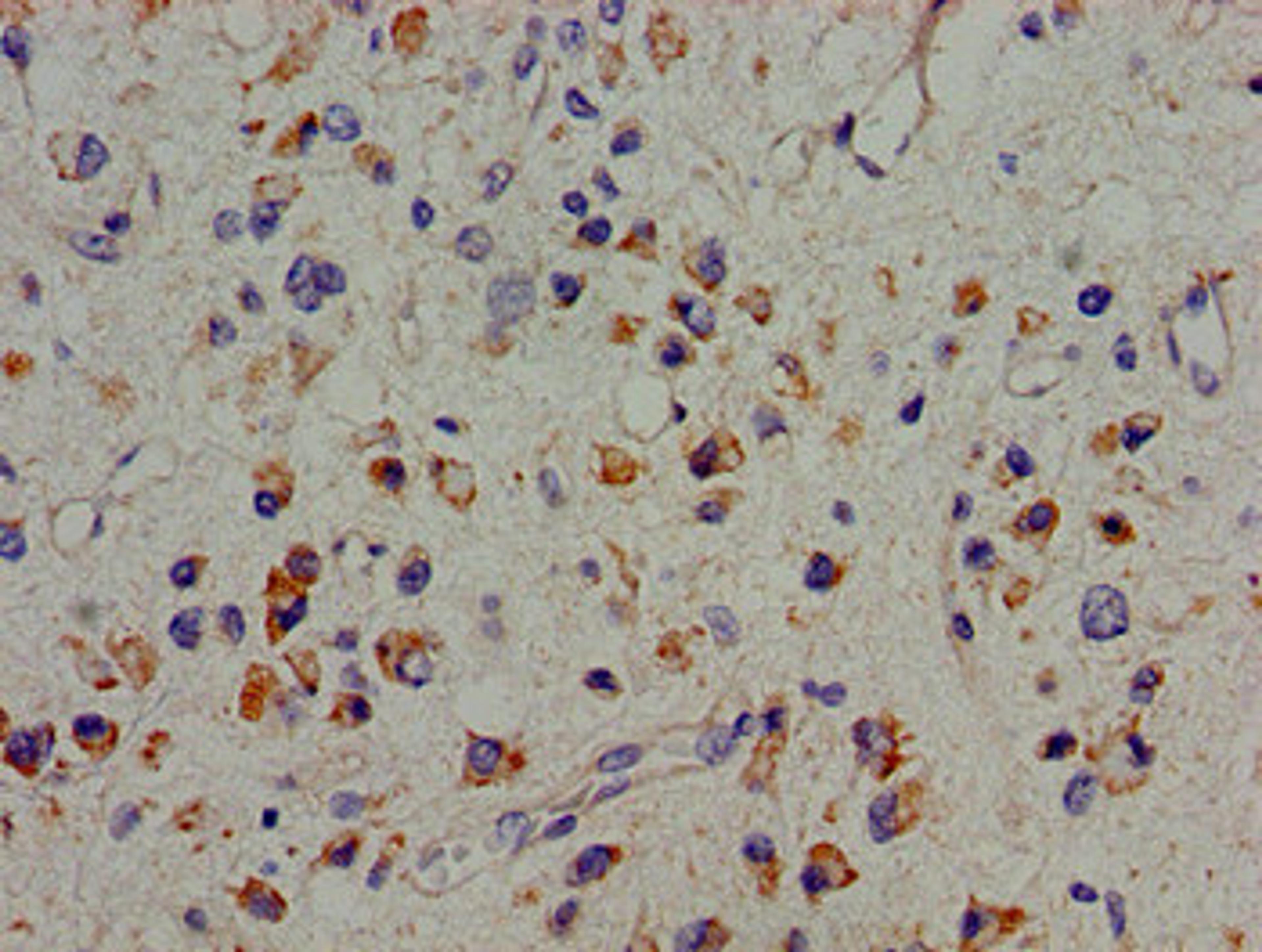 Immunohistochemistry of paraffin-embedded human glioma using CSB-PA613494LA01HU at dilution of 1:100