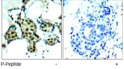 Immunohistochemistry: p38 [p Tyr182] Antibody [NB100-82097] - Immunohistochemical analysis of paraffin-embedded human breast carcinoma tissue, using P38 MAPK (phospho- Tyr182) antibody