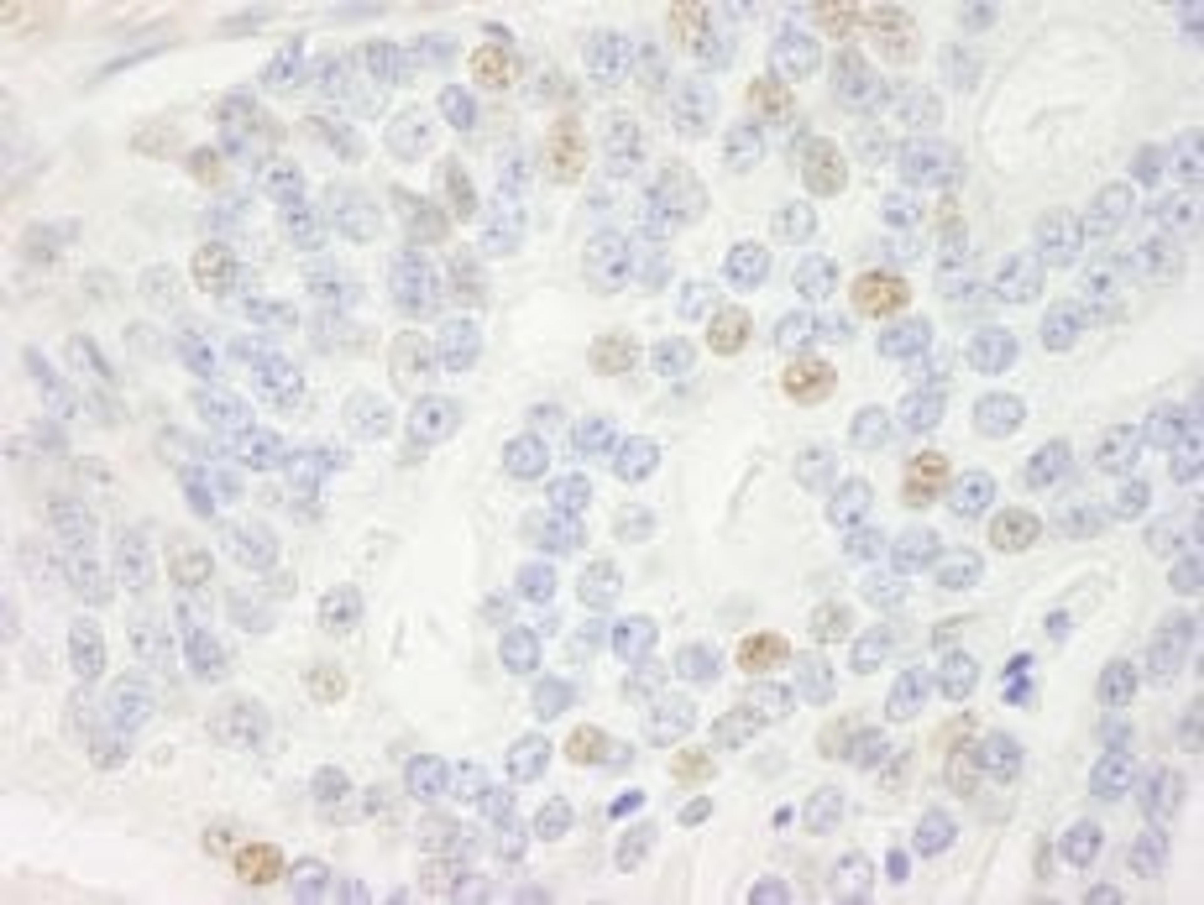 Detection of human p14ARF by immunohistochemistry.