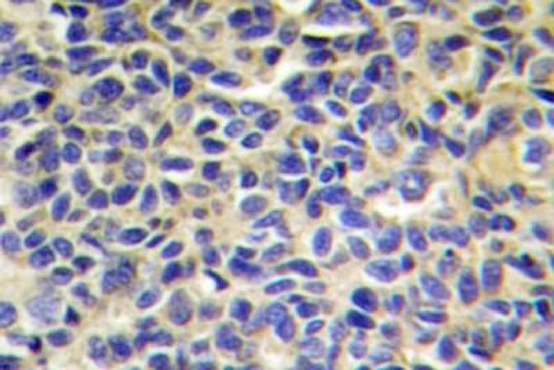 Immunohistochemistry-Paraffin: Aminopeptidase PILS/ARTS1 Antibody [NB100-92405] - ARTS1 Antibody [NB100-92405] Human breast carcinoma tissue.