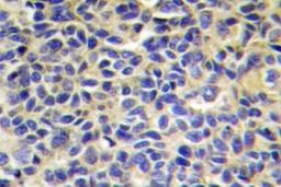 Immunohistochemistry-Paraffin: Aminopeptidase PILS/ARTS1 Antibody [NB100-92405] - ARTS1 Antibody [NB100-92405] Human breast carcinoma tissue.