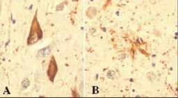 Immunohistochemistry-Paraffin: Ubiquitin Antibody (Ubi-1) [NB300-130] - Staining of Ubiquitin in hippocampal tissue from an Alzheimer patient.