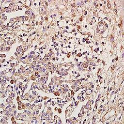 Immunohistochemical analysis of formalin-fixed and paraffin embedded human pulmonitis tissue (Dilution at:1:200) using IL18 Receptor Beta antibody