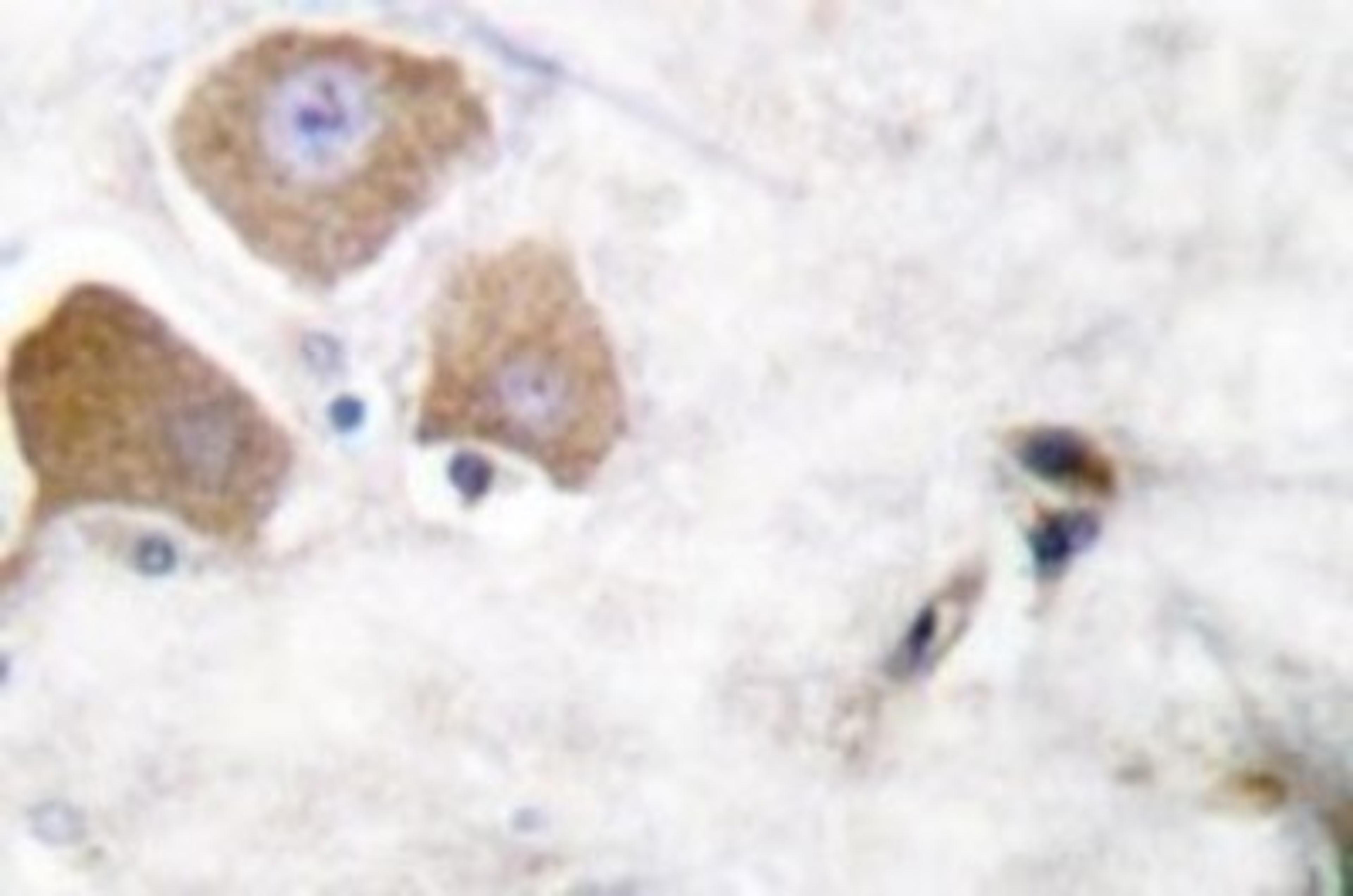 Immunohistochemistry: Tau [Ser396] Antibody [NB100-92652] - Immunohistochemistry (IHC) analyzes of p-Tau  (S396) antibody in paraffin-embedded human breast  carcinoma tissue.