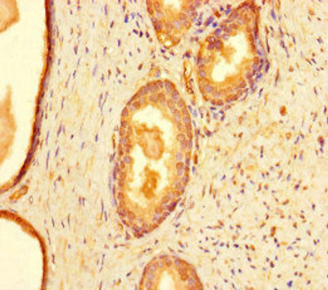 Immunohistochemistry of paraffin-embedded human prostate cancer using CSB-PA004831LA01HU at dilution of 1:100