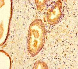 Immunohistochemistry of paraffin-embedded human prostate cancer using CSB-PA004831LA01HU at dilution of 1:100