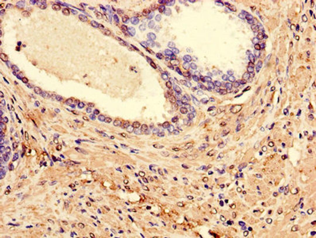Immunohistochemistry of paraffin-embedded human prostate cancer using CSB-PA013068LA01HU at dilution of 1:100