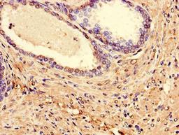 Immunohistochemistry of paraffin-embedded human prostate cancer using CSB-PA013068LA01HU at dilution of 1:100