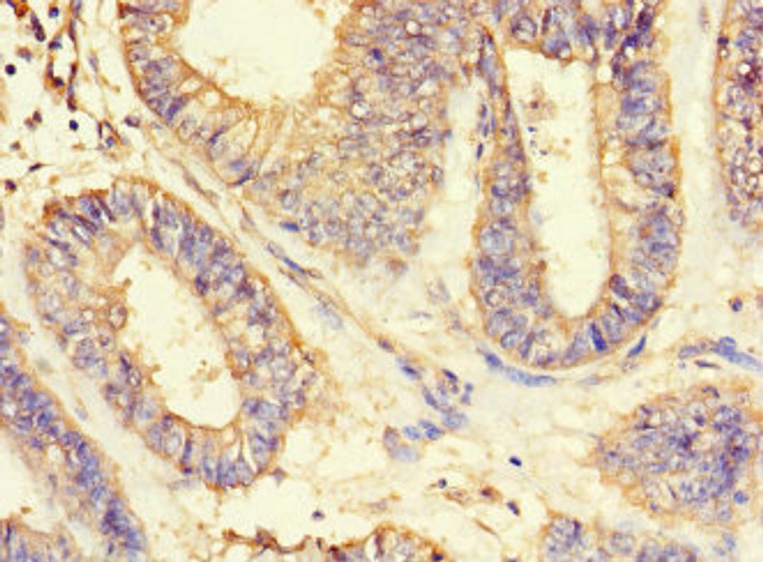 Immunohistochemistry of paraffin-embedded human endometrial cancer using CSB-PA002212LA01HU at dilution of 1:100