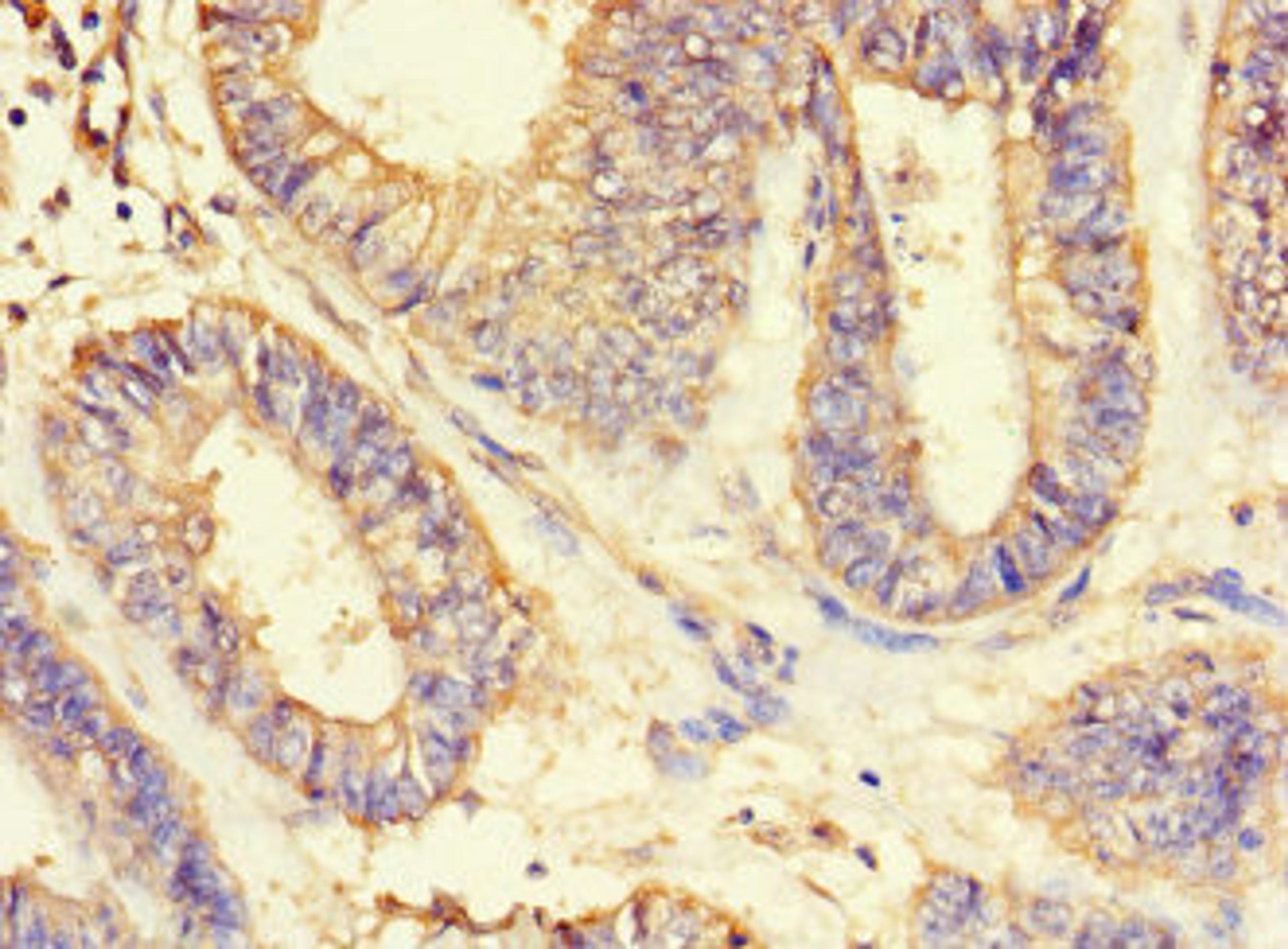 Immunohistochemistry of paraffin-embedded human endometrial cancer using CSB-PA002212LA01HU at dilution of 1:100