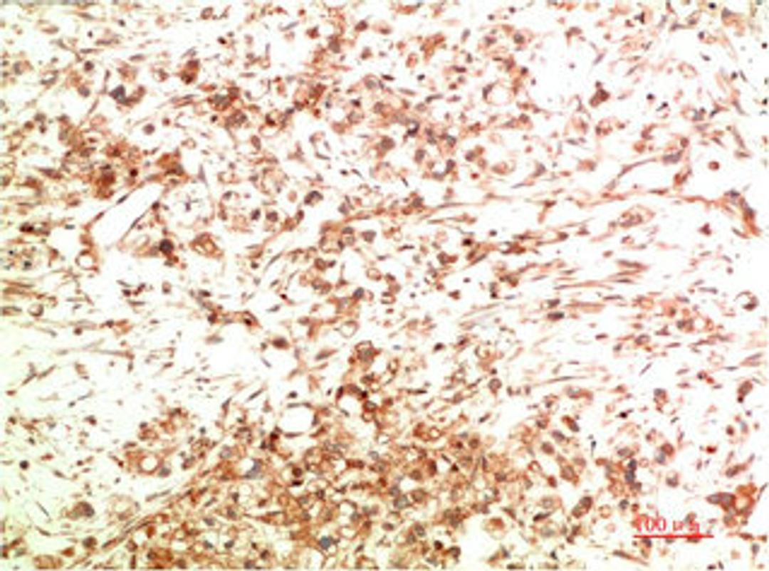 Immunohistochemical analysis of paraffin-embedded Human Ovarian Carcinoma Tissue using ATG5 Mouse mAb diluted at 1:200.
