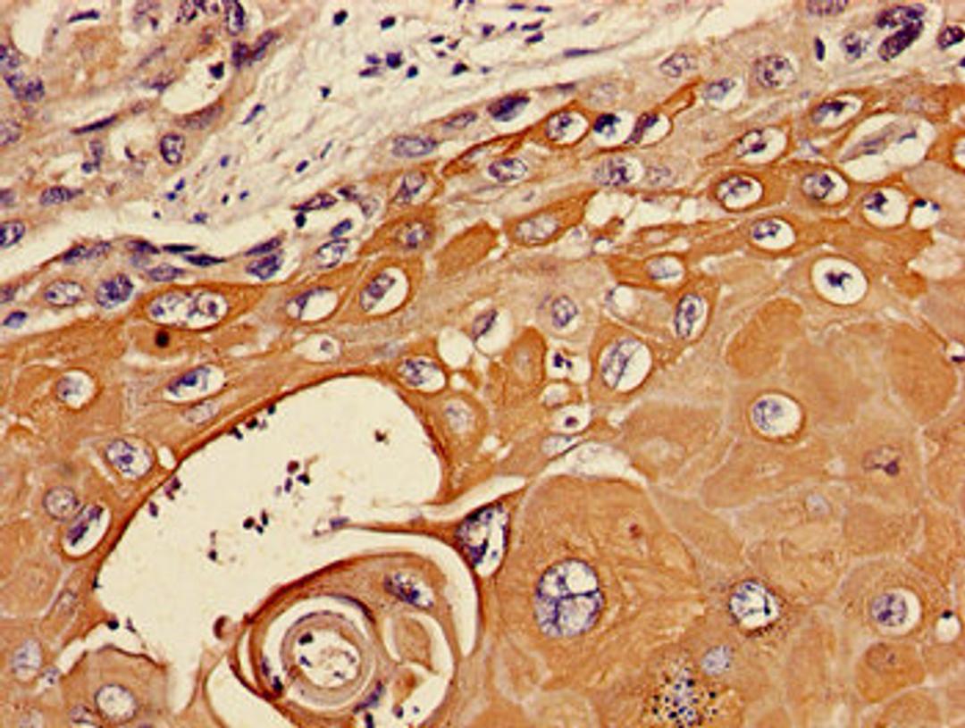 Immunohistochemistry of paraffin-embedded human ovarian cancer using CSB-PA07369A0Rb at dilution of 1:100