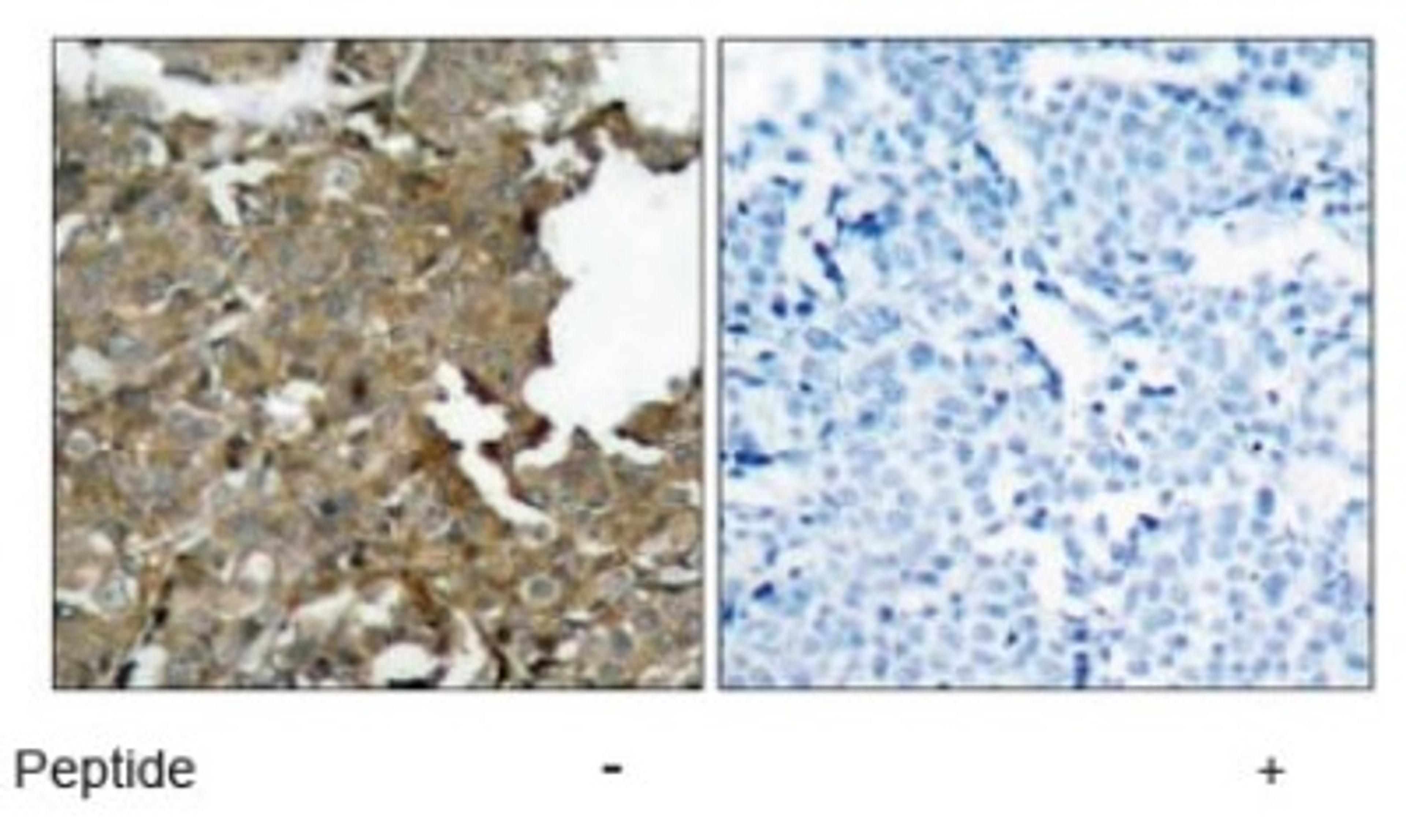 Immunohistochemistry: Cofilin Antibody [NB100-81866] - Immunohistochemical analysis of paraffin-embedded human breast carcinoma tissue using cofilin (Ab- 1022) antibody.