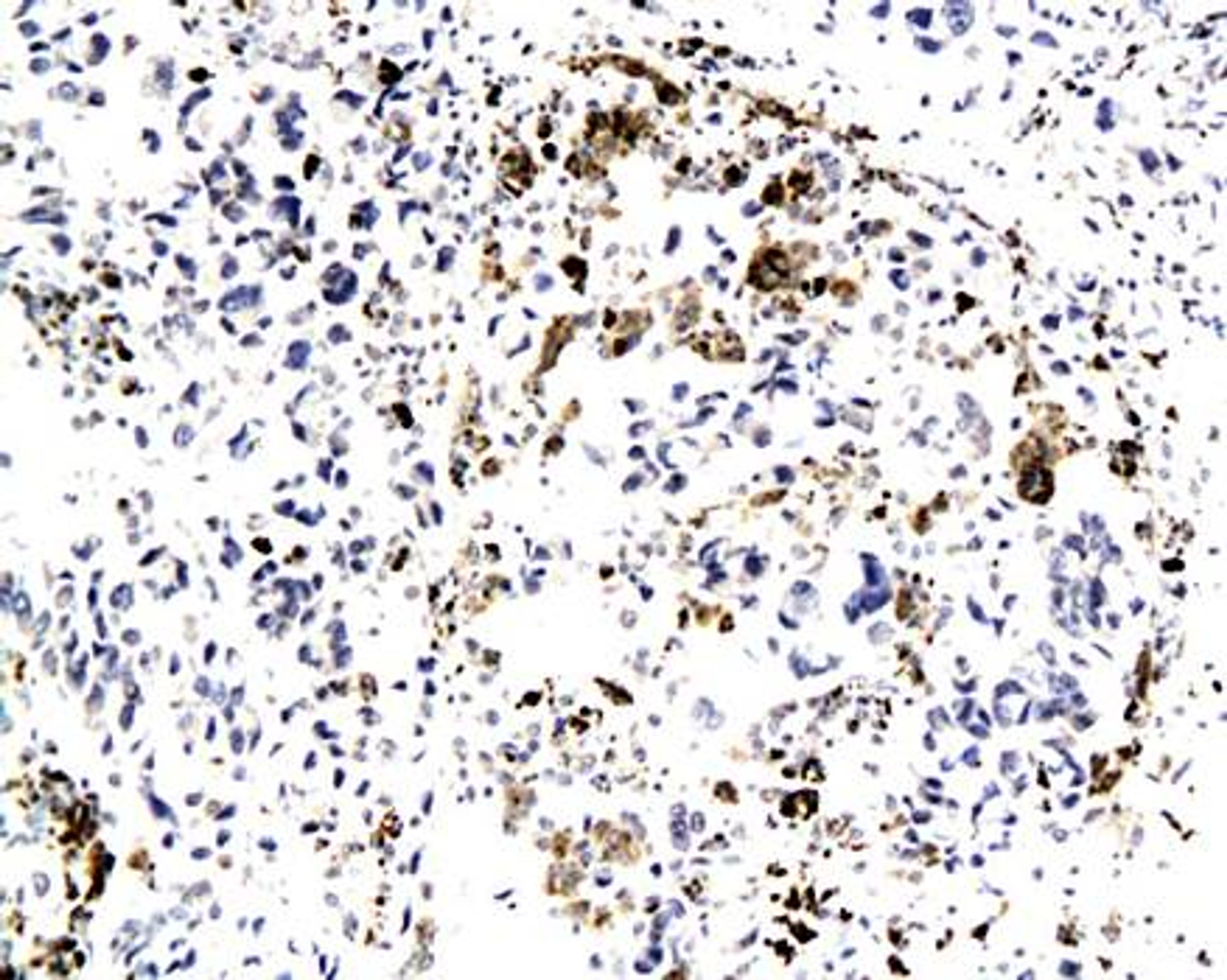 IHC-P of human lung cancer tissue(SFRP1 antibody at 1:200)