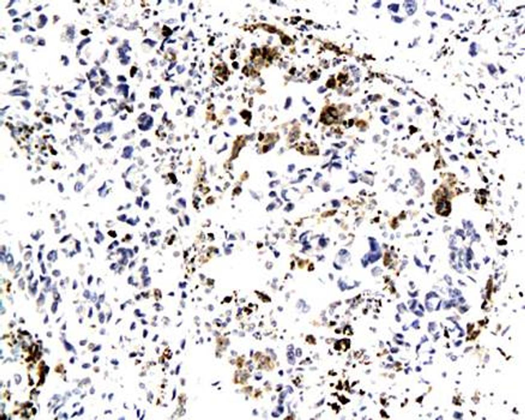 IHC-P of human lung cancer tissue(SFRP1 antibody at 1:200)