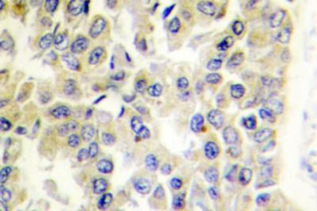 Immunohistochemistry-Paraffin: MARK1/2/3/4 Antibody [NBP1-00910] - Analyzes of MARK1/2/3/4 (N211) pAb in paraffin-embedded human breast carcinoma tissue .