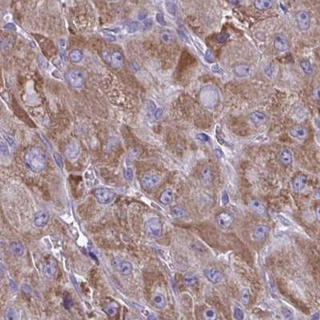 Immunohistochemistry: TVP23A Antibody [NBP2-32556] - liver cancer