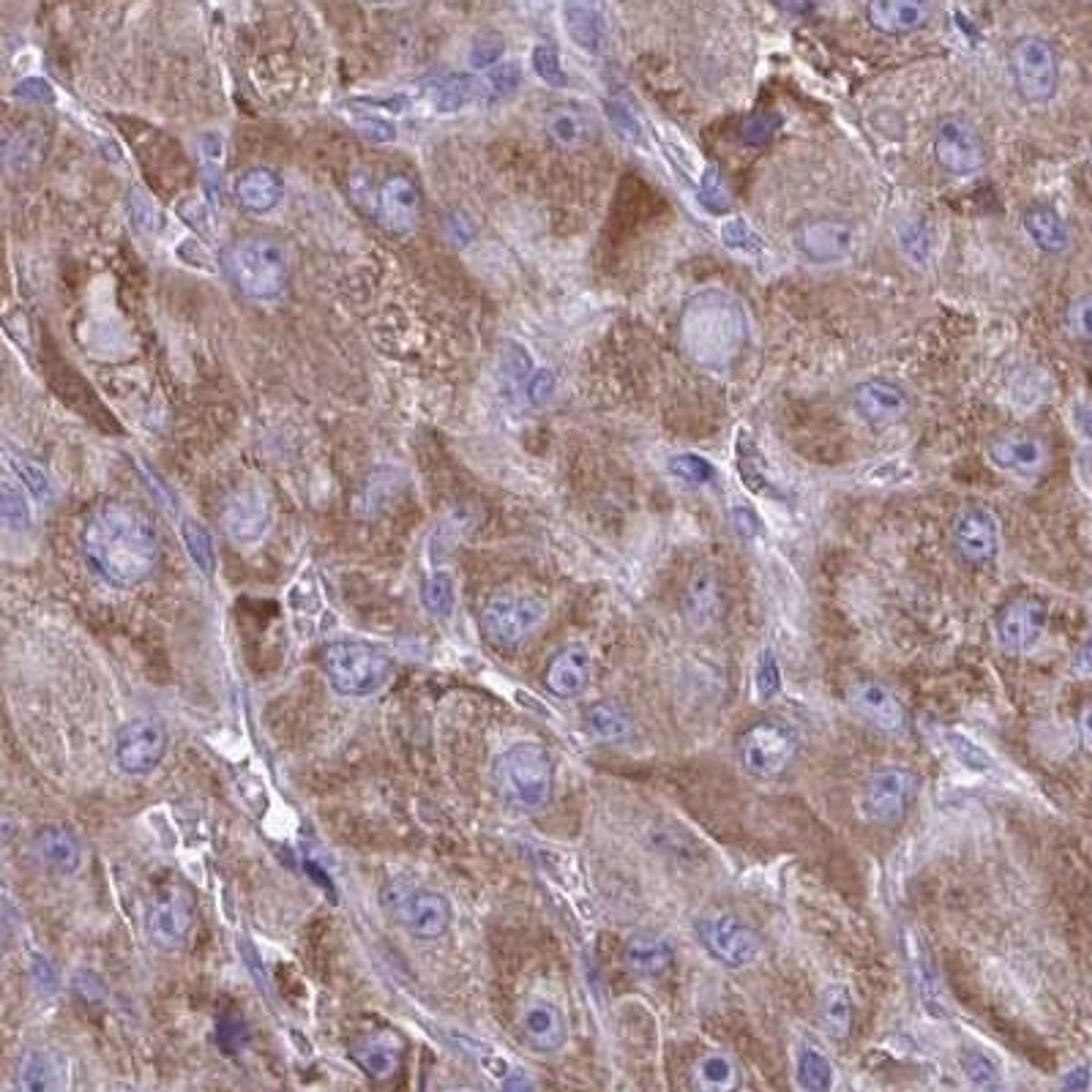 Immunohistochemistry: TVP23A Antibody [NBP2-32556] - liver cancer