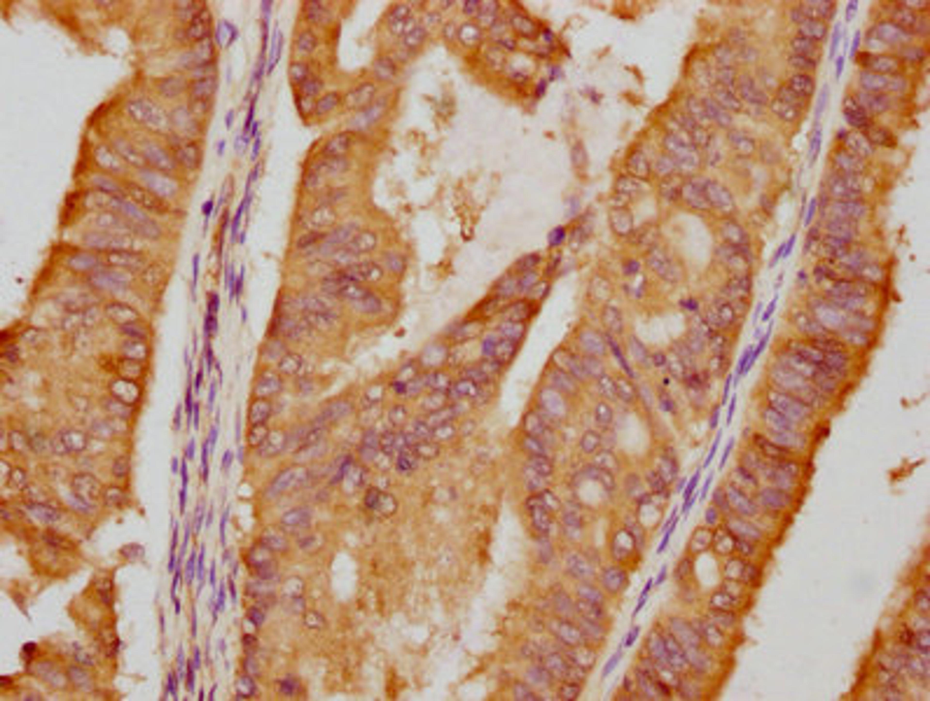IHC image of CSB-RA011087A1HU diluted at 1:87.5 and staining in paraffin-embedded human endometrial cancer performed on a Leica BondTM system. After dewaxing and hydration, antigen retrieval was mediated by high pressure in a citrate buffer (pH 6.0). Section was blocked with 10% normal goat serum 30min at RT. Then primary antibody (1% BSA) was incubated at 4℃ overnight. The primary is detected by a biotinylated secondary antibody and visualized using an HRP conjugated SP system.