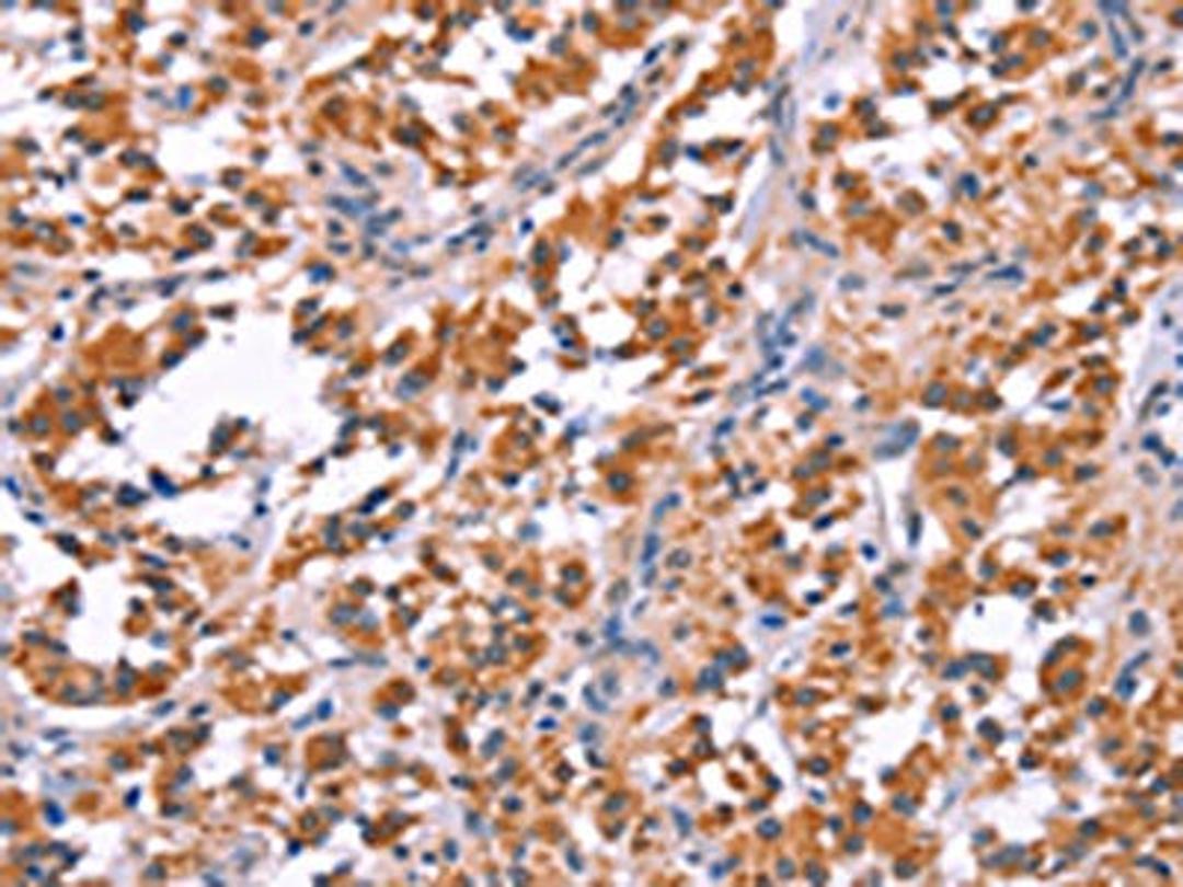 The image on the left is immunohistochemistry of paraffin-embedded Human thyroid cancer tissue using CSB-PA786870(ARC Antibody) at dilution 1/25, on the right is treated with fusion protein. (Original magnification: ×200)