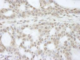 Detection of human ATRX by immunohistochemistry.