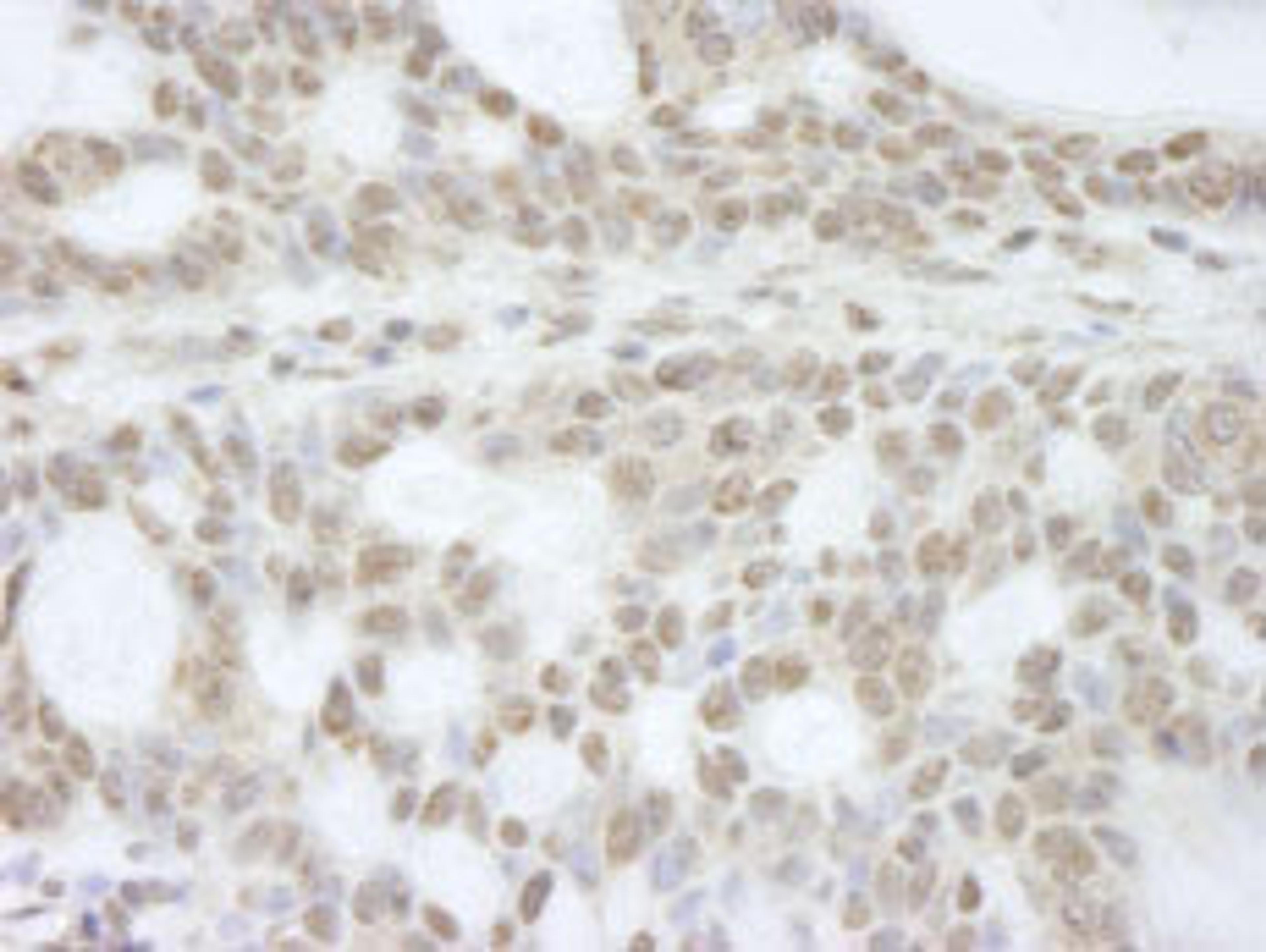 Detection of human ATRX by immunohistochemistry.