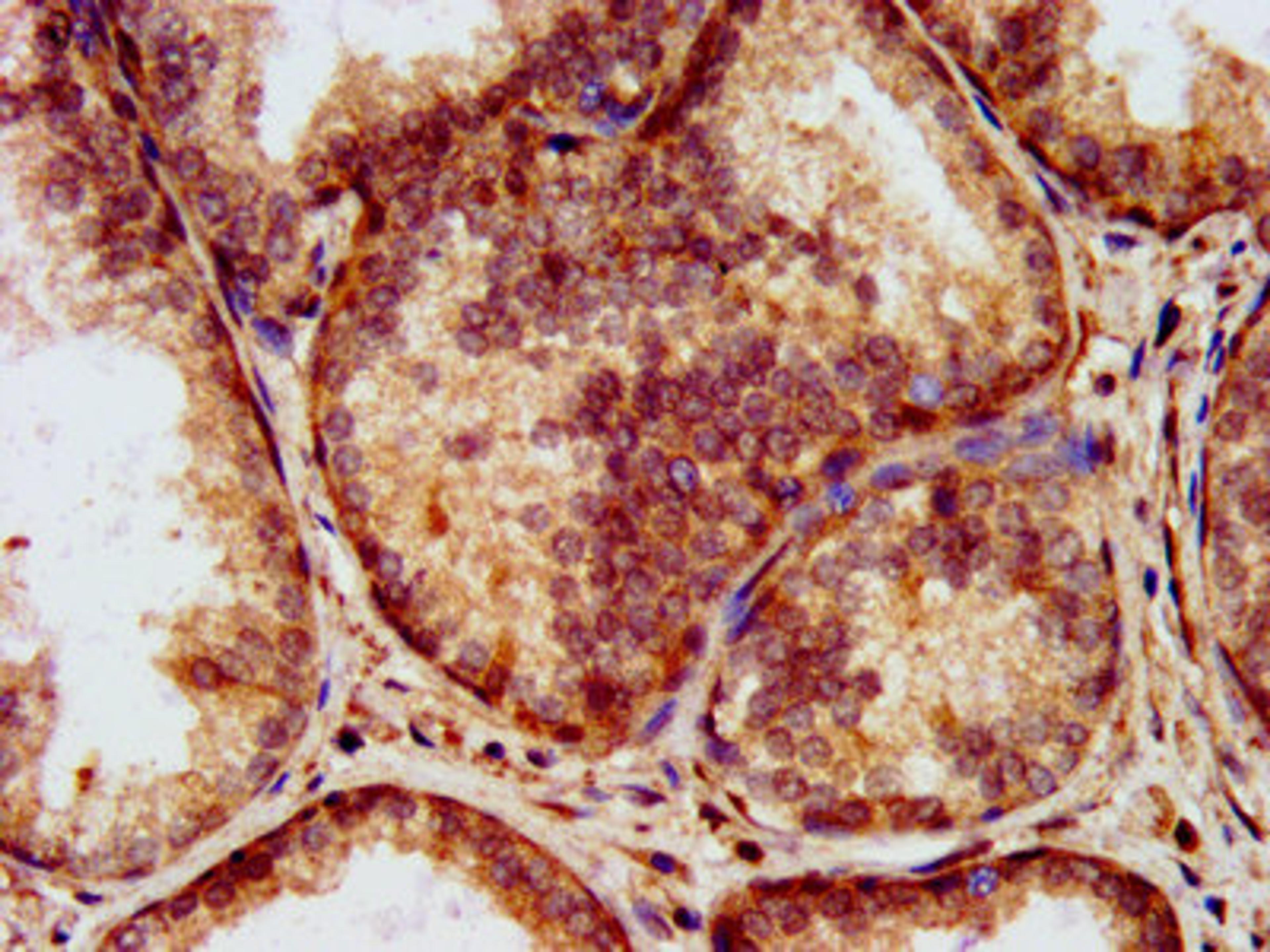 IHC image of CSB-PA012726LA01HU diluted at 1:200 and staining in paraffin-embedded human prostate cancer performed on a Leica BondTM system. After dewaxing and hydration, antigen retrieval was mediated by high pressure in a citrate buffer (pH 6.0). Section was blocked with 10% normal goat serum 30min at RT. Then primary antibody (1% BSA) was incubated at 4&deg;C overnight. The primary is detected by a biotinylated secondary antibody and visualized using an HRP conjugated SP system.
