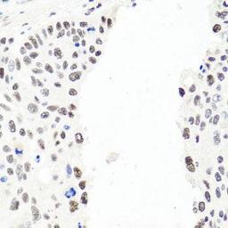 Immunohistochemical staining of human esophageal cancer tissue using EXO1 antibody (dilution of 1:100)