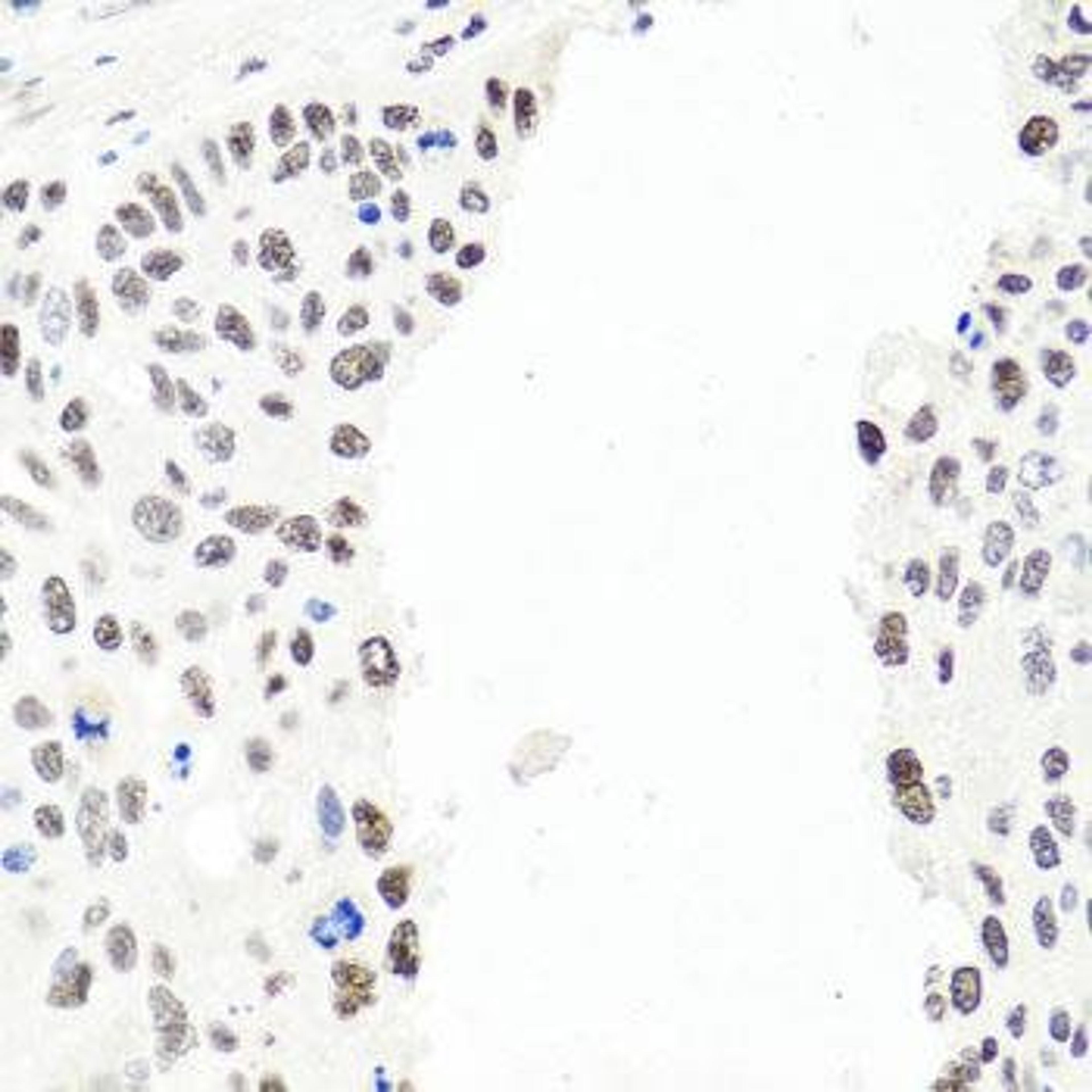 Immunohistochemical staining of human esophageal cancer tissue using EXO1 antibody (dilution of 1:100)