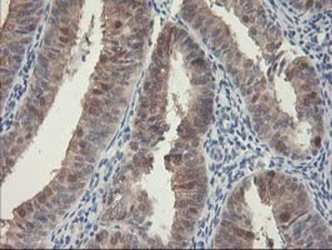 Immunohistochemistry-Paraffin: HspBP1 Antibody (1D5) [NBP2-01168] - Staining of paraffin-embedded Adenocarcinoma of Human endometrium tissue using anti-HspBP1 mouse monoclonal antibody.