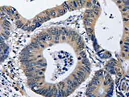 The image on the left is immunohistochemistry of paraffin-embedded Human colon cancer tissue using CSB-PA217611(NFKBID Antibody) at dilution 1/40, on the right is treated with fusion protein. (Original magnification: ×200)