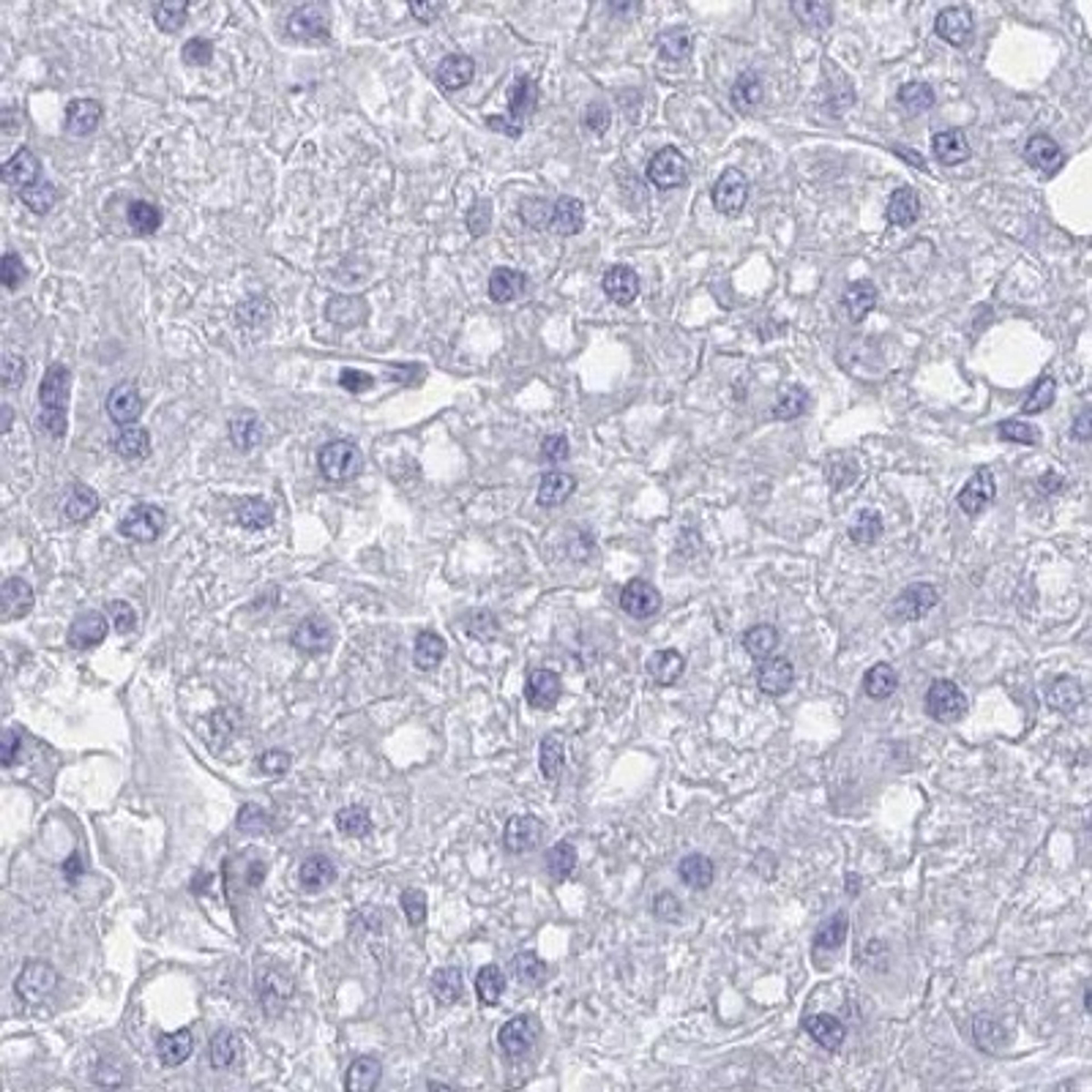 Immunohistochemistry: OR2T1 Antibody [NBP2-32375] - liver cancer